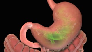 Stomach Ulcer  Nucleus Health [upl. by Adnorat]