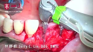 Implant placement with simultaneous GBR [upl. by Ikceb]