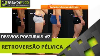 Retroversão Pélvica  Equilíbrio Pélvico  Desvios Posturais 7 [upl. by Lustig]