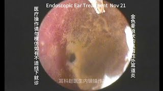 Ear wax removal Golden earwax fungus dry sheet cleaning 20241121 [upl. by Ahsied]