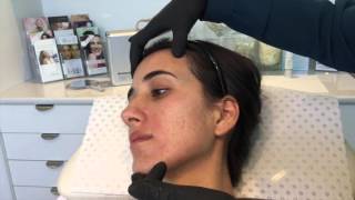 Dermapen Skin Needling for Acne amp Scarring [upl. by Aymik]