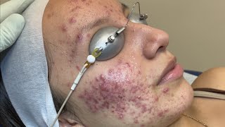 Severe Acne Follow Up Discussion [upl. by Nagad227]