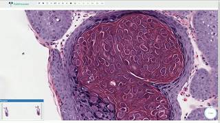 Molluscum Contagiosum  Histopathology [upl. by Ainadi]