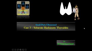 Ultrasound Case 3  Subacute Hashimotos Thyroiditis [upl. by Nuahc447]