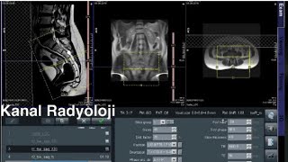 Koksiks MR Nasıl Çekilir KANAL RADYOLOJİ MR Çekmeyi Öğreniyorum Siemens Magnetom Essenza [upl. by O'Dell]