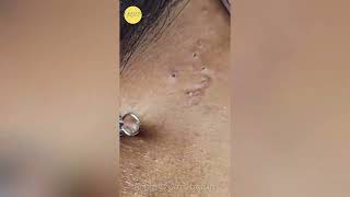 Intense Blackhead Extraction Watch Every PoreCleansing Moment [upl. by Ihcelek]