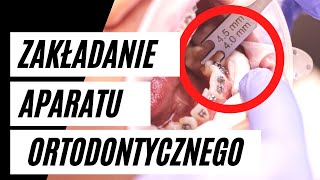 Zakładanie aparatu ortodontycznego  krok po kroku  VLOG3 [upl. by Donoho]