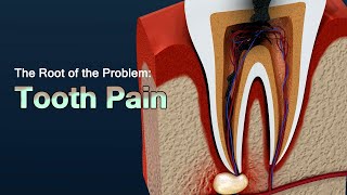 Causes of Severe Toothache and How to Relieve the Pain [upl. by Melba]