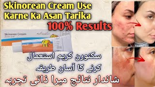 How To Use Azelaic Acid  Azelaic acid kaise use kare  how to use skinoren azelaic [upl. by Levinson447]