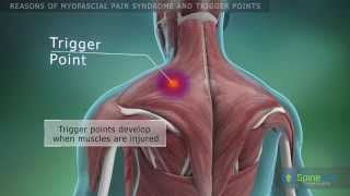 Myofascial pain syndrome and trigger points Reasons [upl. by Alyakcim]