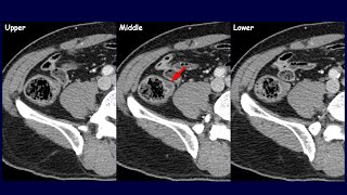 Is this an appendiceal lesion  Colitis cystica profunda amp Gastritis cystica profunda [upl. by Ruhnke]