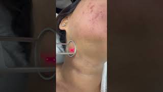 co2 fractional laser treatment [upl. by Wende683]