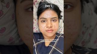 Anyone can go from quotFace full of acnequot to quotclear glass skinquot in 30 days shorts skincare acne [upl. by Prussian96]