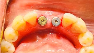 Guided Implant Surgery with 31 41 Neodent Straumann Dental Implant [upl. by Leamiba]