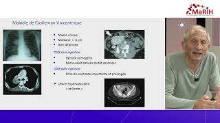 REPLAY 🩸 WEBCAST MaRIH  Maladie de Castleman amp Anatomopathologie [upl. by Rufina]