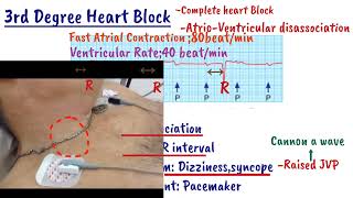 AV Heart Block  First degree heart Block  Mobitz type1  Mobitz type2  Complete heart Block [upl. by Assila474]