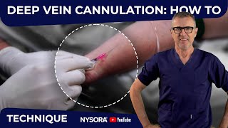 DEEP VEINS CANNULATION STRATEGY [upl. by Assereht380]