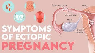 HEAVY SIGNS And SYMPTOMS Of ECTOPIC Pregnancy MOMMATTERS [upl. by Casabonne828]