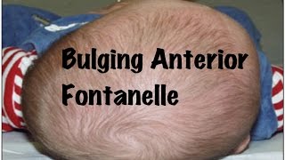 Quick Pediatrics Causes for Bulging of Anterior Fontanelle [upl. by Colas]