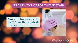 Port Wine Stain Causes Syndromes Symptoms Diagnosis and Treatment  Facial Birth Marks [upl. by Odnalref968]