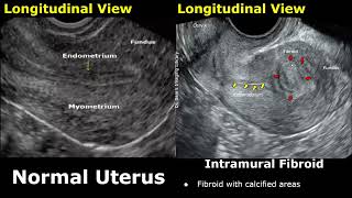 Uterus Ultrasound Normal Vs Intramural Fibroid Images  Uterine Leiomyomas USG Cases [upl. by Crandall]