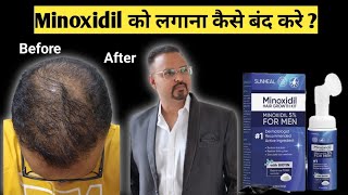 How to stop minoxidil aftre hair regrowth step by step Minoxidil ko lagana kaise band kare [upl. by Alimat]