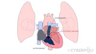 Pulmonalisstenose [upl. by Sordnaxela586]