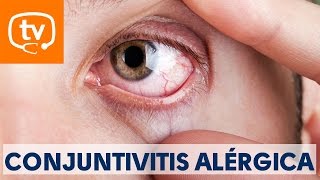 Claves sobre la conjuntivitis alérgica [upl. by Kwasi]