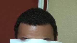 Dense Black Hair Transplant Hairline Restoration Result Bald Treatment Dr Diep wwwmhtacliniccom [upl. by Nyraa]