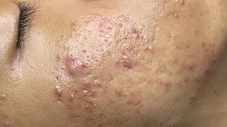 ACNE TREATMENT VU QUYNH MI  Perennial Blackheads On Boy Face 2024FULL [upl. by Karoline]