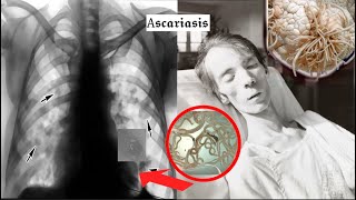 The HORRIFIC History of Ascariasis [upl. by Leeland]