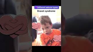 متلازمة درافيت Dravet syndrome [upl. by Pomfrey]