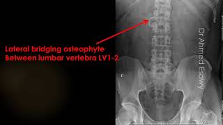 case 604 Lateral bridging osteophyte [upl. by Aninnaig]