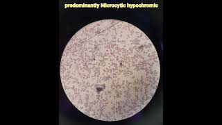 Hematologyanaemiamicrocytic hypochromicpathologymedical [upl. by Perceval]