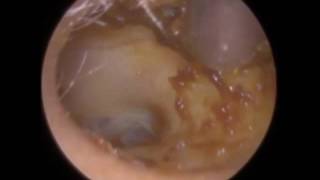 Ear Wax Removal in Shaky Head  Mr Neel Raithatha The Hear Clinic [upl. by Ahsal]