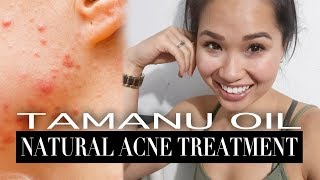 Tamanu Oil  Natural Acne Treatment [upl. by Housum499]