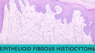 Epithelioid fibrous histiocytoma benign ALK1 skin tumor ALK gene fusion pathology dermpath [upl. by Fonville]