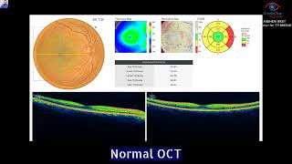 Optical Coherence Tomography Eyeby DR Jignesh Gala Crystal Clear Eye Hospital 91 7718885245 [upl. by Gavriella326]