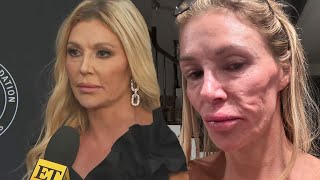 Brandi Glanville Questions If Parasite Is to Blame for Disfigured Face [upl. by Gladi]