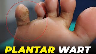 The ultimate guide to painless plantar wart removal  Plantar Wart Remove  Wart Removel viral [upl. by Seadon]