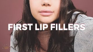 MY FIRST LIP FILLERS  Swelling bruising amp the final result [upl. by Clari]