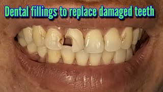 Dental fillings to replace damaged teeth [upl. by Rayner]