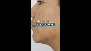 ARREGLA Tu PIEL y QUITA el ACNE Con REMEDIOS CASEROS desarrollopersonalacneconpielperfectapiel [upl. by Edveh]