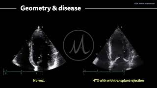 〖Echocardiography〗 Heart transplant rejection amp the left ventricle [upl. by Marlon]