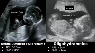 Obstetric Ultrasound Normal Vs Abnormal Images  Fetal Placenta Umbilical Cord Pathologies USG [upl. by Galasyn600]