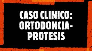 ORTODONCIA PRÓTESIS POR MICRODONCIA DE LATERALES SUPERIORES Y ODONTOLOGÍA ESTÉTICA [upl. by Sayres985]