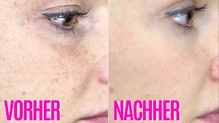 WAS IST MICRONEEDLING UND WARUM DU ES BRAUCHST  BASIS WISSEN FÜR ANFÄNGER  KathisFinest [upl. by Narah451]