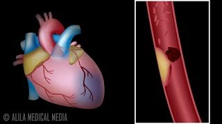 Myocardial Infarction and Coronary Angioplasty Treatment Animation [upl. by Laleb]