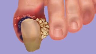 ASMR treatment for ingrown nail remove worms infected with legs treat and remove dameged toenail [upl. by Truc]