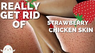 HOW TO GET RID OF STRAWBERRY LEGS  No More Bumpy Skin Keratosis Pilaris kp or Chicken Skin [upl. by Divod]